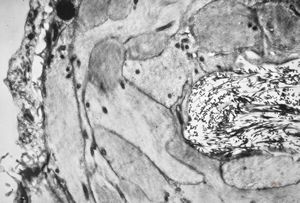 M,6y. | the wall of an arachnoid cyst M,6y. | the wall of an arachnoid cyst
